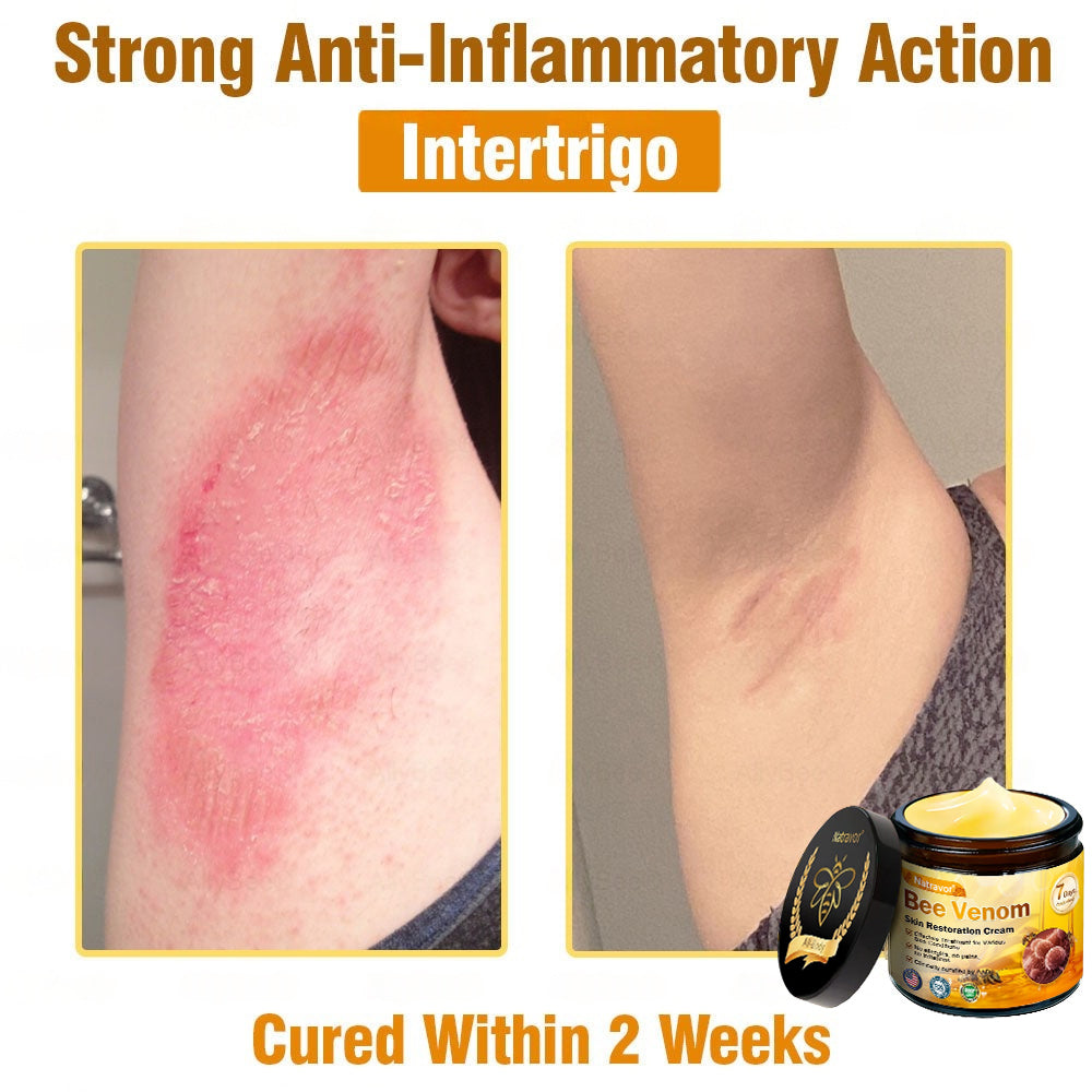 Dermatology Official: Natravor® Skin Treatment Cream Anti-aging, Hydrating, Skin Repair, Even Tone, Acne and Dark Spot Treatment, Wart and Mole Removal, Psoriasis Relief🤝
