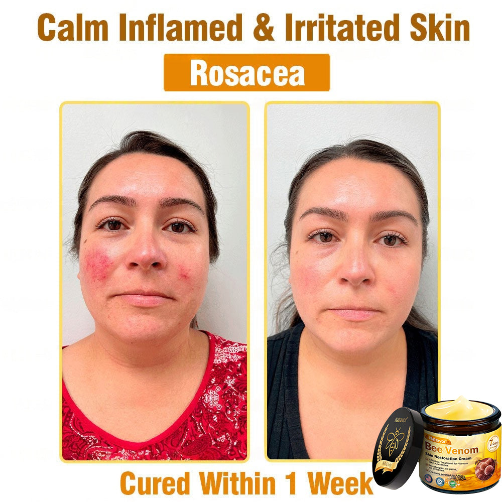 Dermatology Official: Natravor® Skin Treatment Cream Anti-aging, Hydrating, Skin Repair, Even Tone, Acne and Dark Spot Treatment, Wart and Mole Removal, Psoriasis Relief🤝