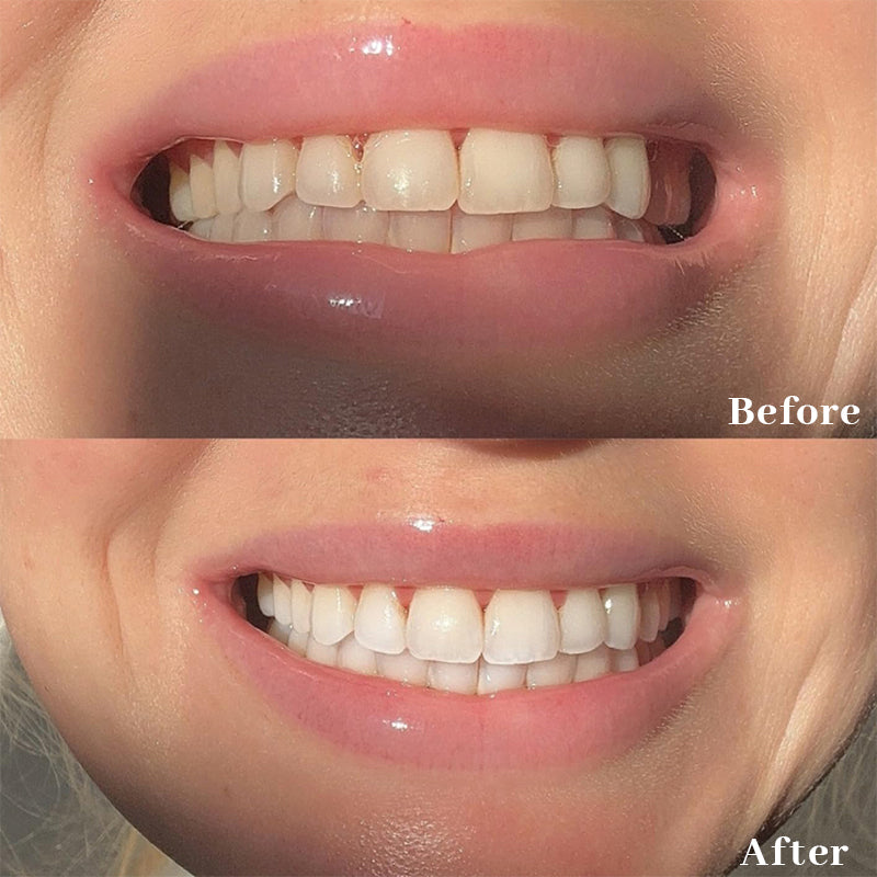 Natravor™ Teeth Whitening Strips, Non-peroxide, Fluoride Free & Vegan, 28 Strips (14-day Treatment)