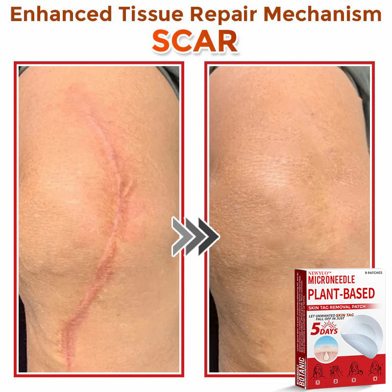 🔥🔥Natravor™-MicroNeedle Plant-based Skin Tag Removal Patch 🇺🇸 Made in the USA