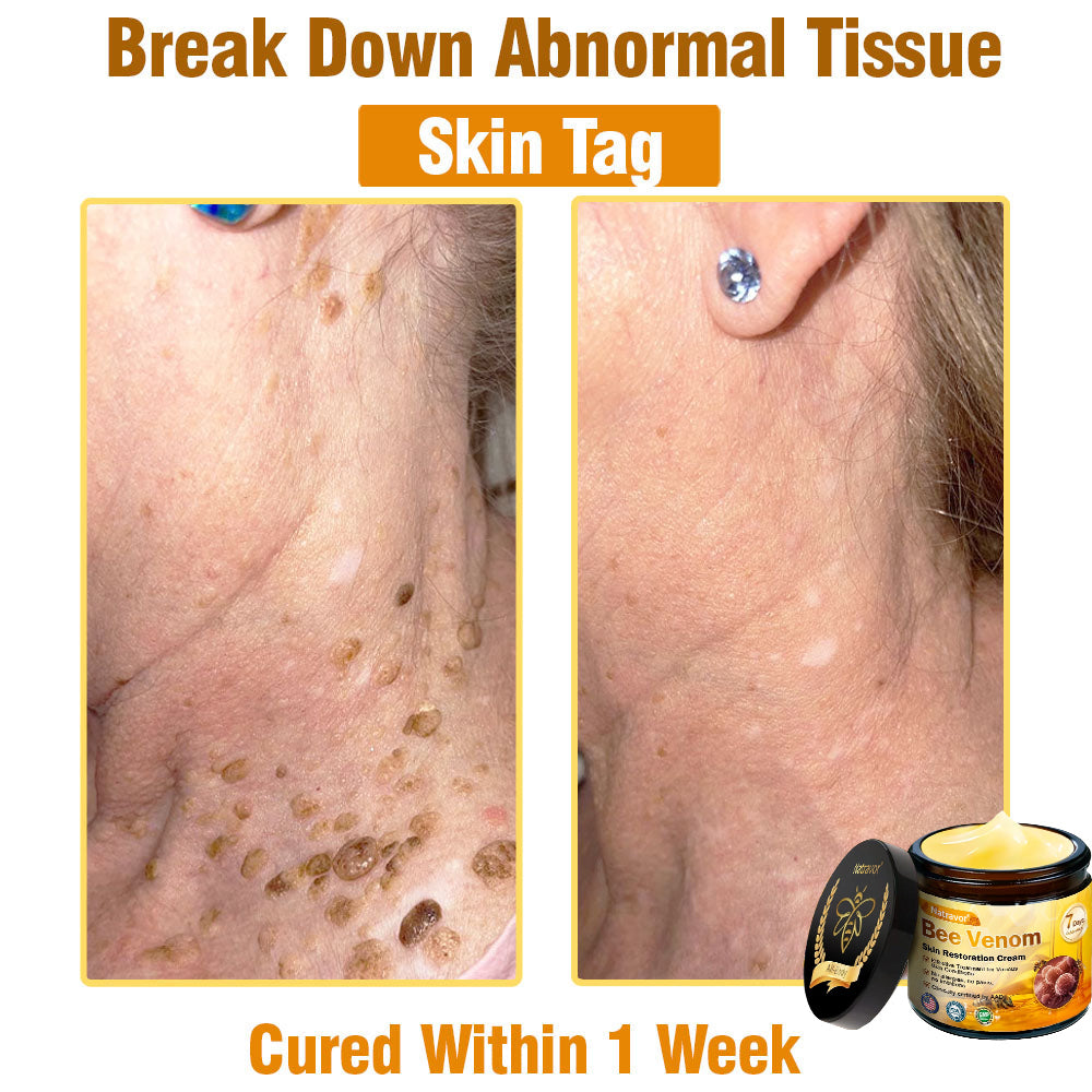 Dermatology Official: Natravor® Skin Treatment Cream Anti-aging, Hydrating, Skin Repair, Even Tone, Acne and Dark Spot Treatment, Wart and Mole Removal, Psoriasis Relief👍