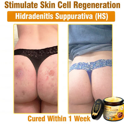 Dermatology Official: Natravor® Skin Treatment Cream Anti-aging, Hydrating, Skin Repair, Even Tone, Acne and Dark Spot Treatment, Wart and Mole Removal, Psoriasis Relief👍