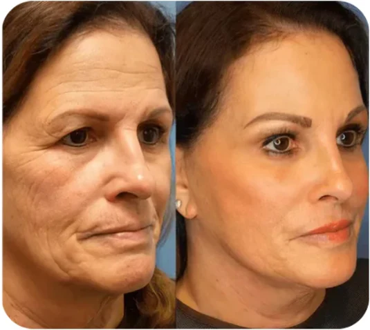 ✨Natravor™-Facial firming cream
