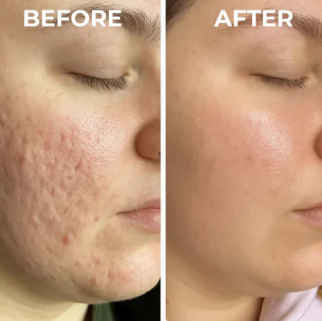 🔥🔥Dual Action Real Deep Collagen Sheets for both wrinkle smoothing and new or old scar fading-Natravor™