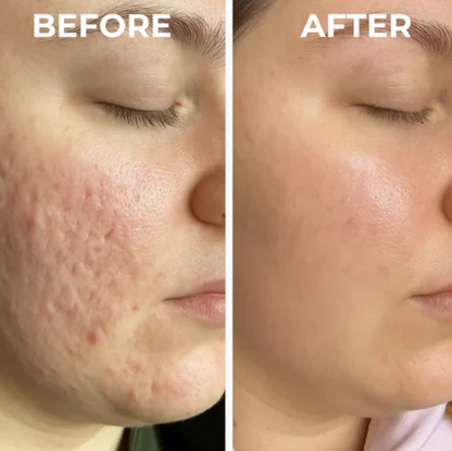 🔥🔥Dual Action Real Deep Collagen Sheets for both wrinkle smoothing and new or old scar fading-Natravor™