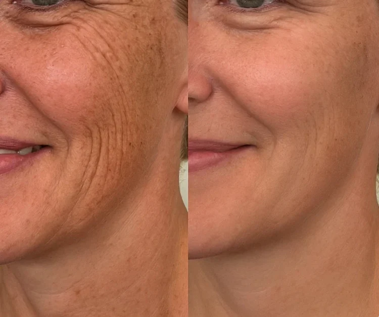 🔥🔥Dual Action Real Deep Collagen Sheets for both wrinkle smoothing and new or old scar fading-Natravor™
