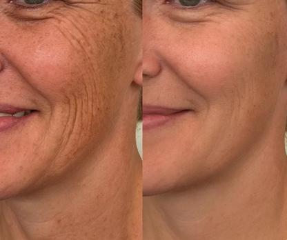 🔥🔥Dual Action Real Deep Collagen Sheets for both wrinkle smoothing and new or old scar fading-Natravor™