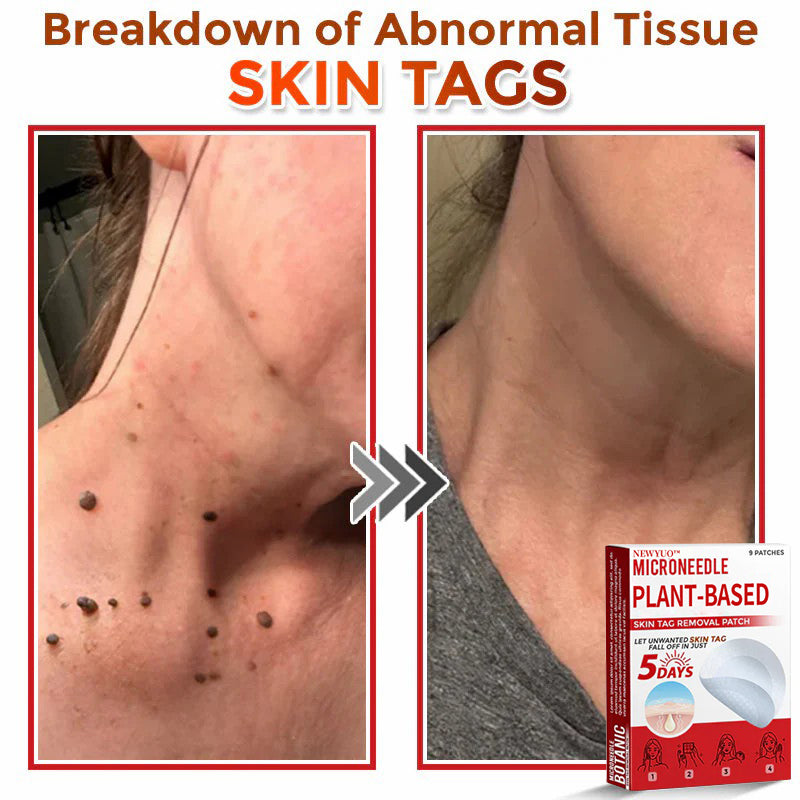 🔥🔥Natravor™-MicroNeedle Plant-based Skin Tag Removal Patch 🇺🇸 Made in the USA