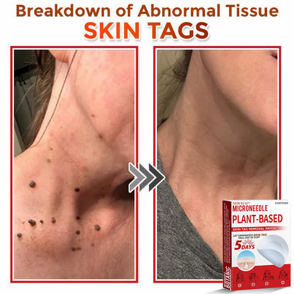 🔥🔥Natravor™-MicroNeedle Plant-based Skin Tag Removal Patch 🇺🇸 Made in the USA