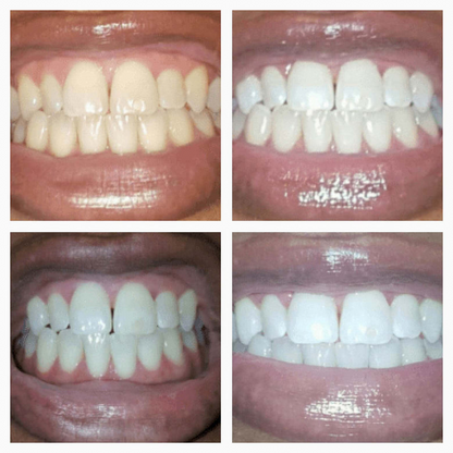 🔥Buy 1 get 1 free Extra-Strength Teeth Whitening Serum Pen + Dual-Peroxide Formula & Xylitol