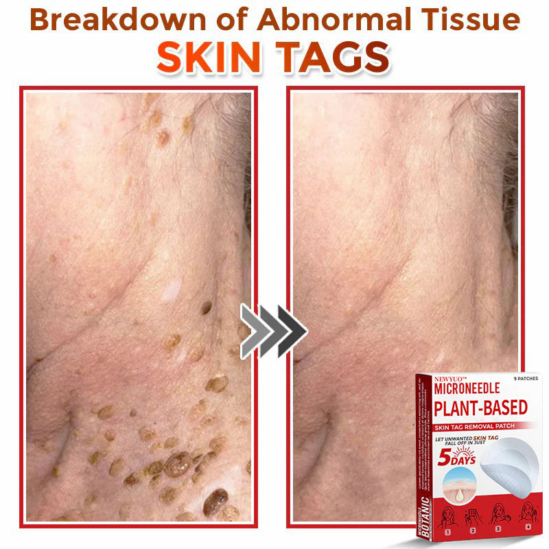 🔥🔥Natravor™-MicroNeedle Plant-based Skin Tag Removal Patch 🇺🇸 Made in the USA