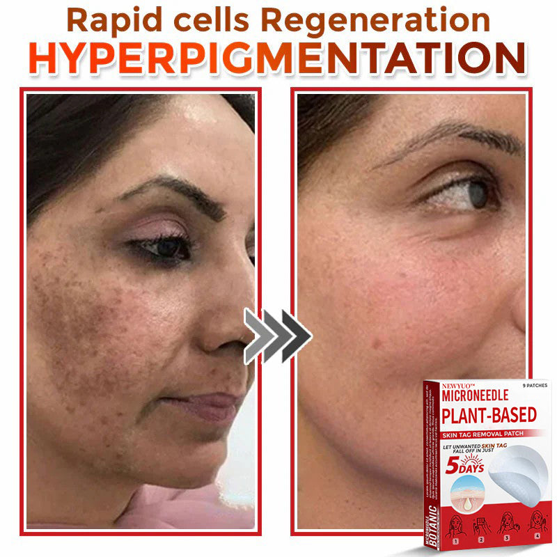 🔥🔥Natravor™-MicroNeedle Plant-based Skin Tag Removal Patch 🇺🇸 Made in the USA
