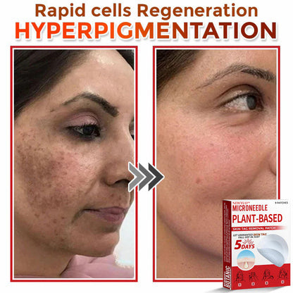 🔥🔥Natravor™-MicroNeedle Plant-based Skin Tag Removal Patch 🇺🇸 Made in the USA