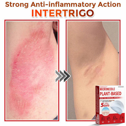 🔥🔥Natravor™-MicroNeedle Plant-based Skin Tag Removal Patch 🇺🇸 Made in the USA