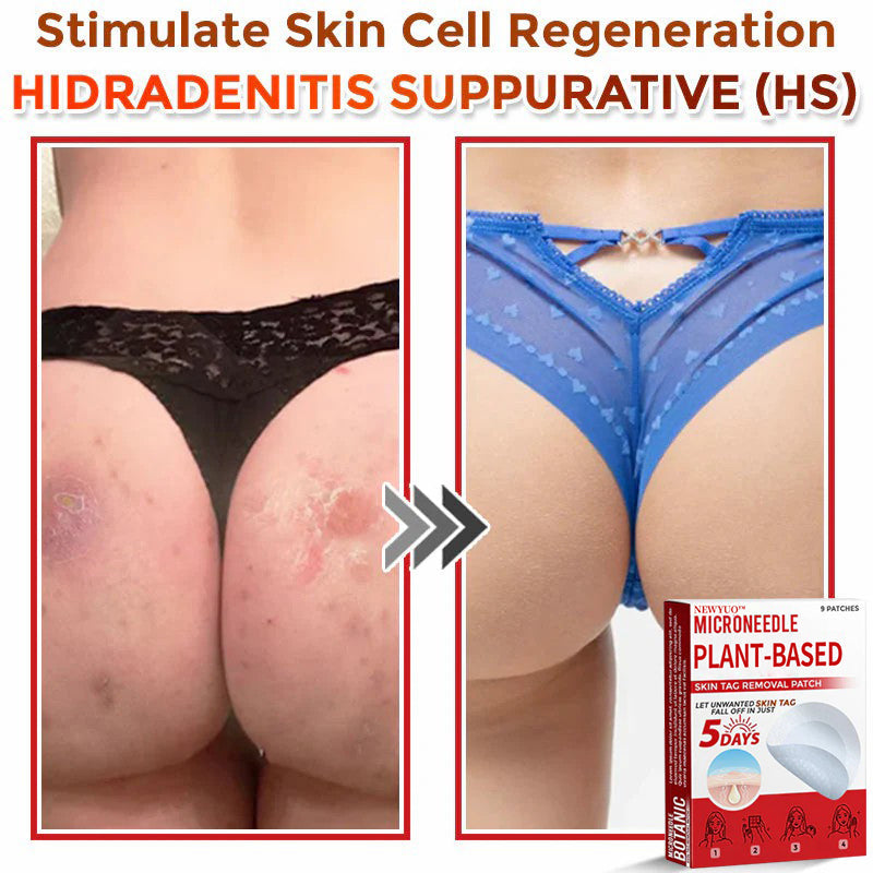 🔥🔥Natravor™-MicroNeedle Plant-based Skin Tag Removal Patch 🇺🇸 Made in the USA