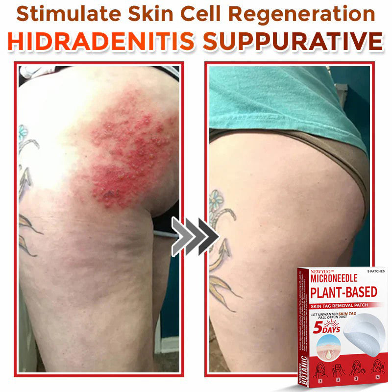 🔥🔥Natravor™-MicroNeedle Plant-based Skin Tag Removal Patch 🇺🇸 Made in the USA