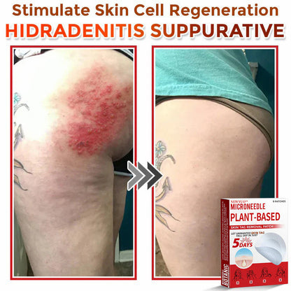 🔥🔥Natravor™-MicroNeedle Plant-based Skin Tag Removal Patch 🇺🇸 Made in the USA