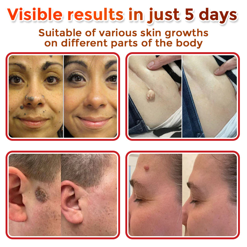 🔥🔥Natravor™-MicroNeedle Plant-based Skin Tag Removal Patch 🇺🇸 Made in the USA